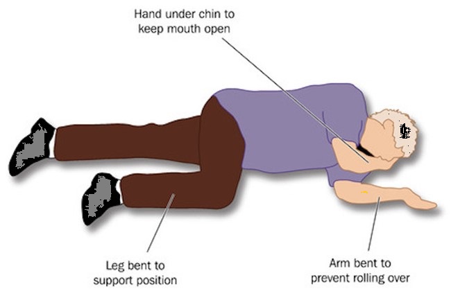 an example of recovery position
